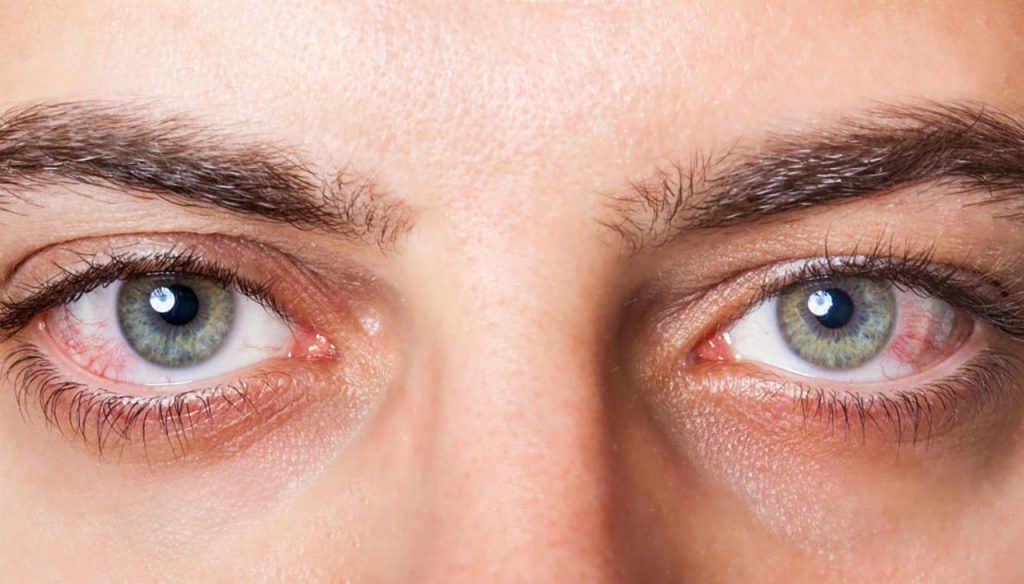 Tìm hiểu về bệnh khô mắt thường gặp trong mùa hè